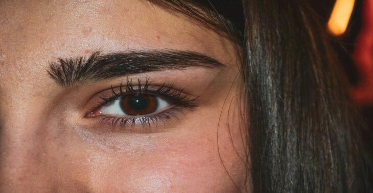 Tratamiento de ojeras en Los Olivos ¿Por qué elegir a Diva Centro Médico EStético Los Olivos sede Antúnez de Mayolo?